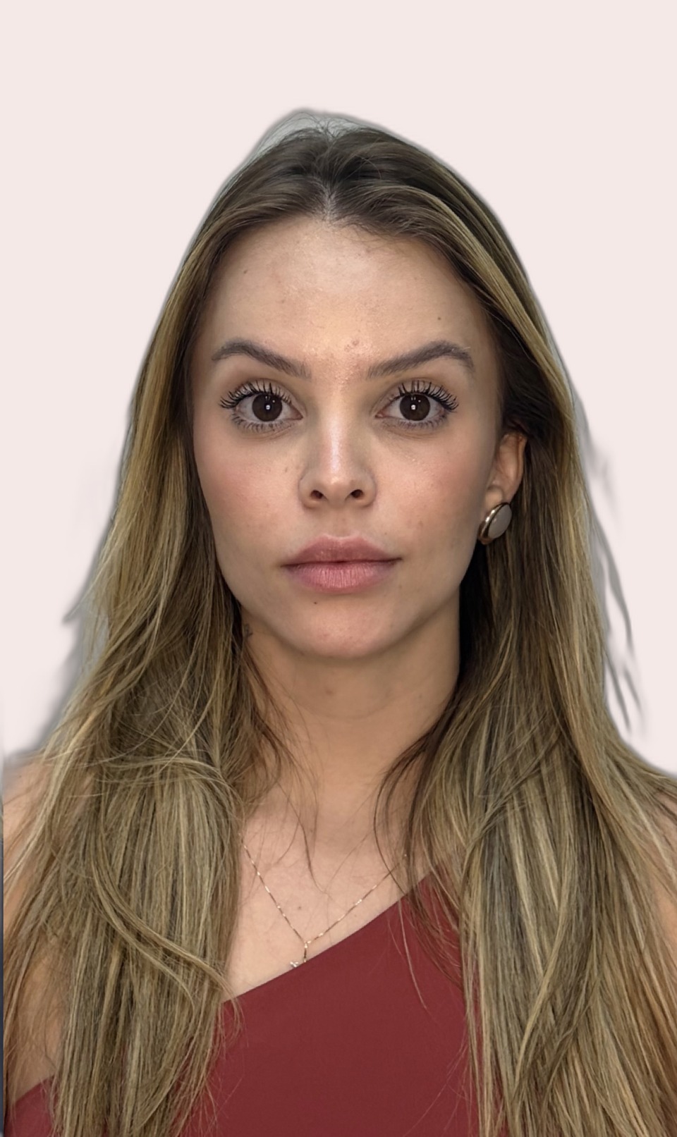 Depois da toxina botulínica