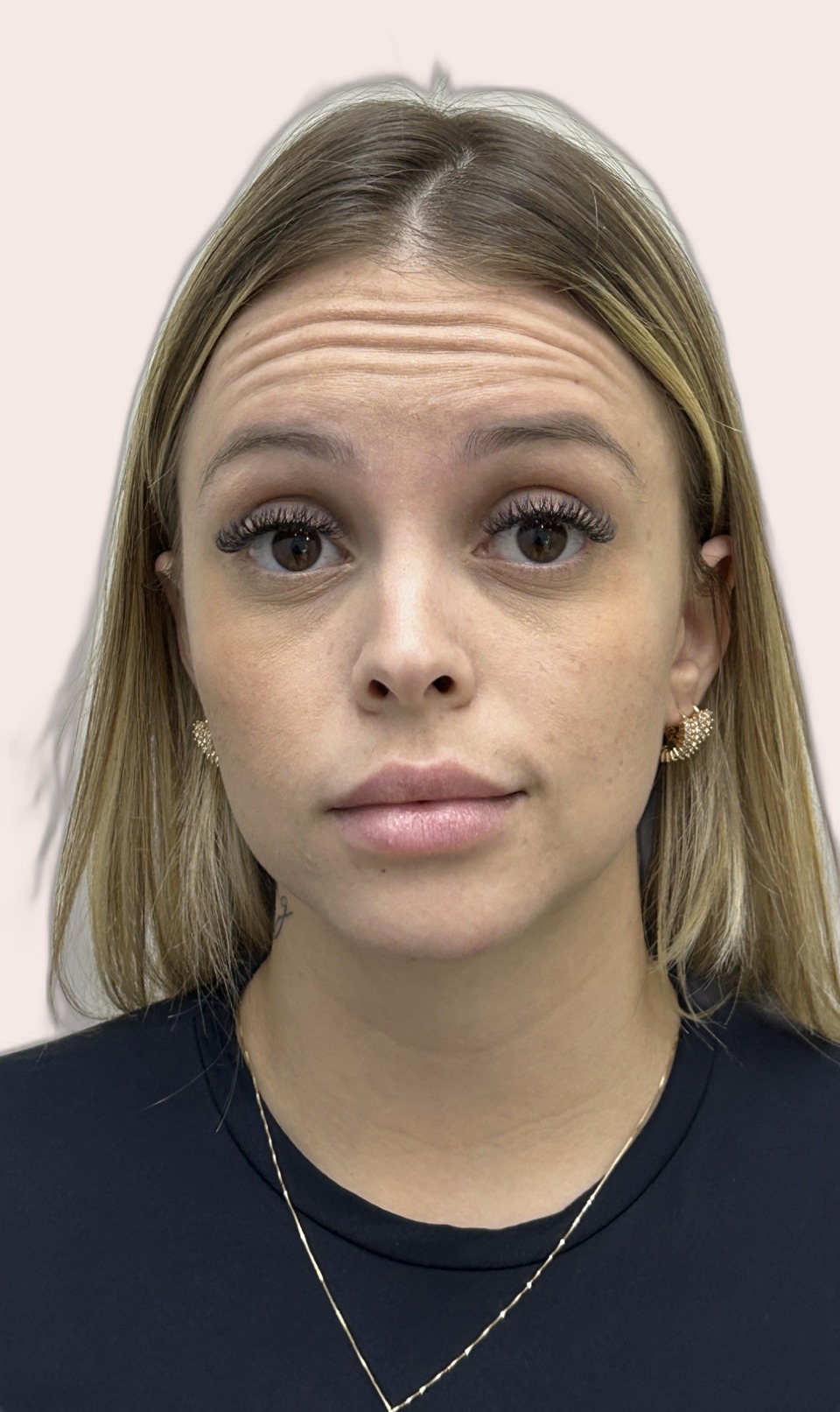 Antes da toxina botulínica