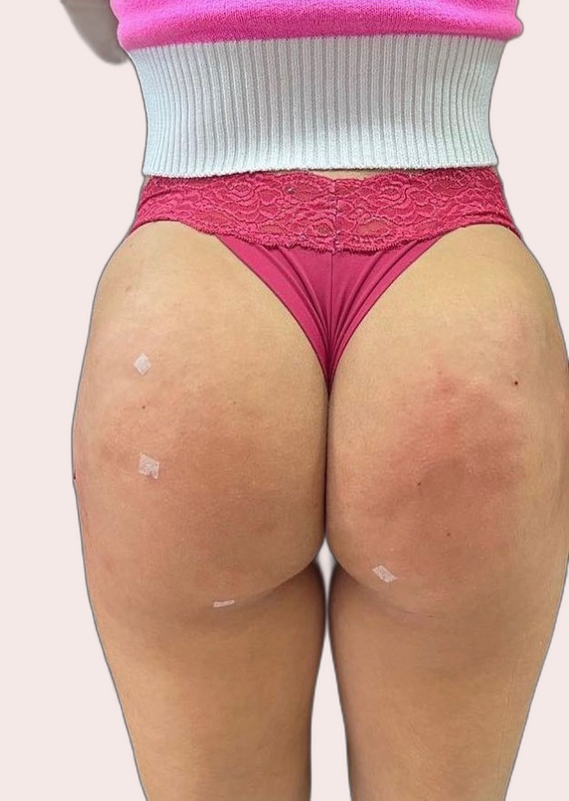 Depois da harmonização glútea