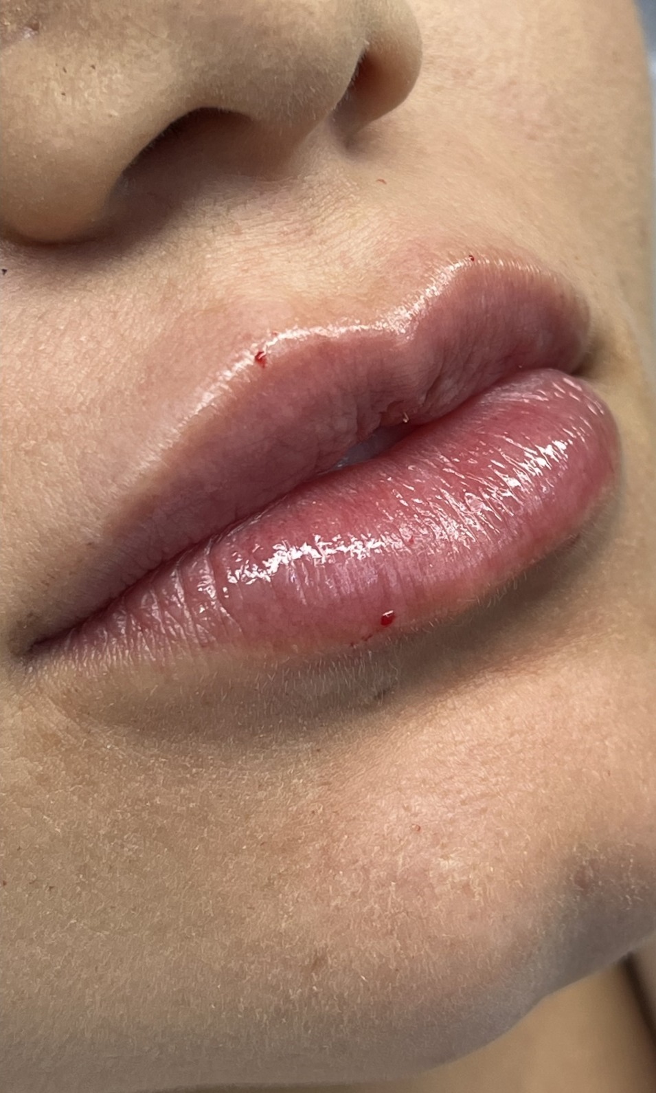 Depois do preenchimento labial
