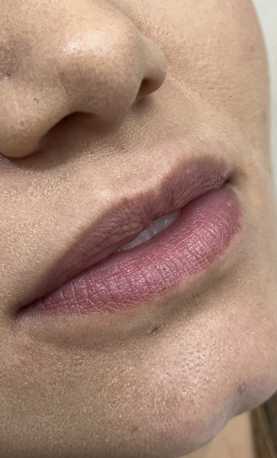Antes do preenchimento labial