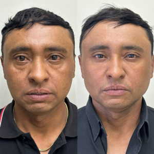 Harmonização Masculina